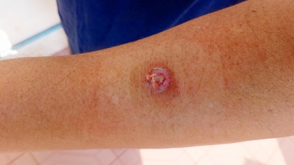 Closeup...The wound on the arm .. caused by the removal of small polyps .. The wound looks like a hole in the middle.