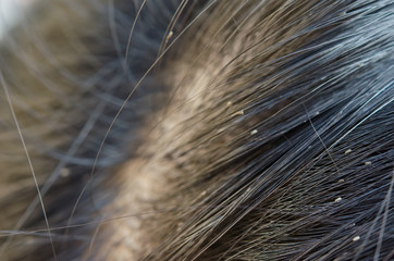 Lice eggs on the child's head cause head itching. Girls with long hair are more likely to develop lice than short hair.