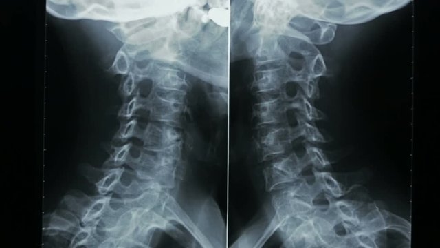 Zoom-out of X-ray, spine cell bone, human cervical bone.