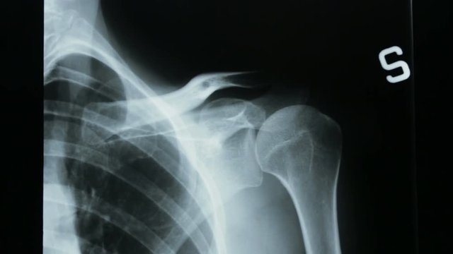 Zoom out on the radiograph details of the human bones of the shoulder