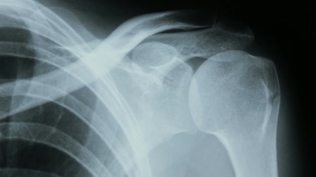 Zoom in on the radiograph details of the human bones of the shoulder