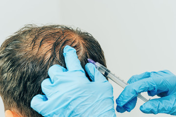 Mesotherapy of hair and head. Injections in the head. Fighting hair loss in men. Men's bald spot in...