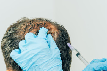 Mesotherapy of hair and head. Injections in the head. Fighting hair loss in men. Men's bald spot in...
