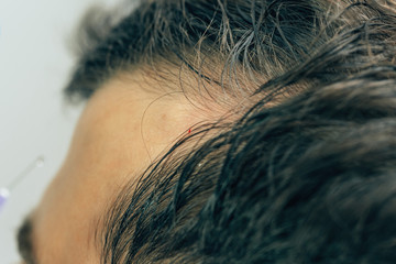 A bald spot on the forehead of a young man. The texture of the rare hair on the head of a man. Male...