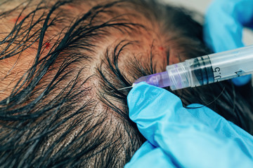 Mesotherapy of hair and head. Injections in the head. Fighting hair loss in men. Men's bald spot in...