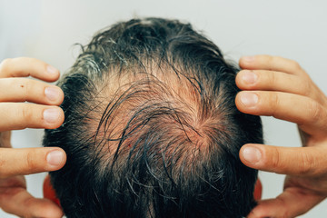 Mesotherapy of hair and head. Traces of injections on the head after therapy. Male pattern...