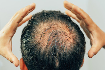 Mesotherapy of hair and head. Traces of injections on the head after therapy. Male pattern...