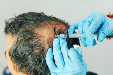 Mesotherapy of hair and head. Injections in the head. Fighting hair loss in men. Men's bald spot in...