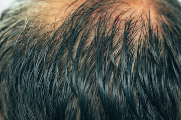 The texture of the rare hair on the head of a man. Mesotherapy of hair and head. Traces of...
