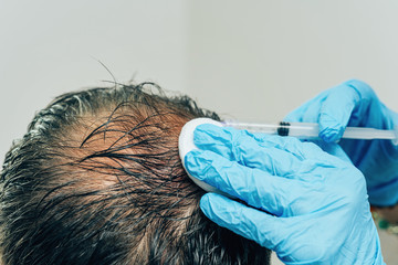 Mesotherapy of hair and head. Injections in the head. Fighting hair loss in men. Men's bald spot in...