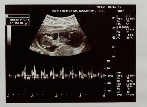 Ultrasound scan of future baby