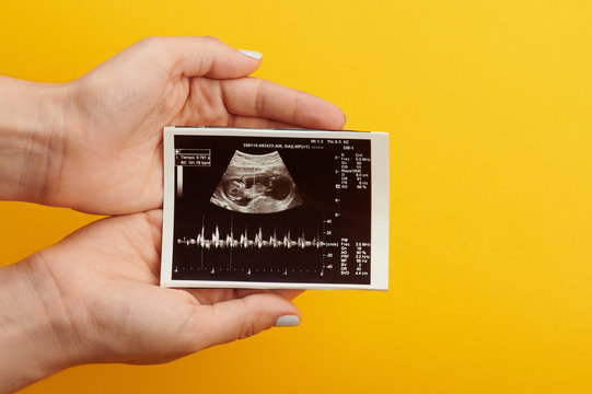 Ultrasound picture of baby in woman belly