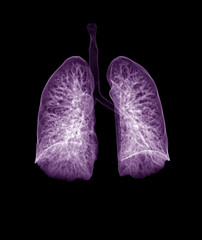 CT Chest or CT lung 3d rendering image with purple color showing Trachea and lung in respiratory system.