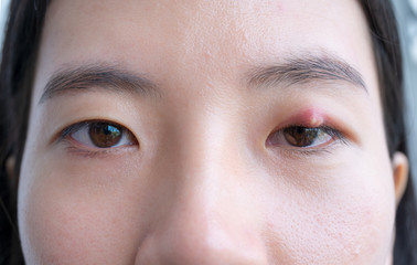 Close up of Asian young woman with brown eye with stye infection. Eyelid abscess, hordeolum in...