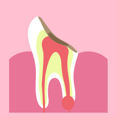 Tooth and initial caries on it on a pink background. Vector illustration.