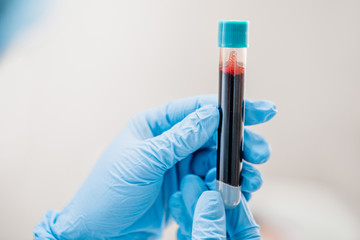 Plasma lifting - Closeup of doctor's hand with test tube with blood - analysis and diagnosis