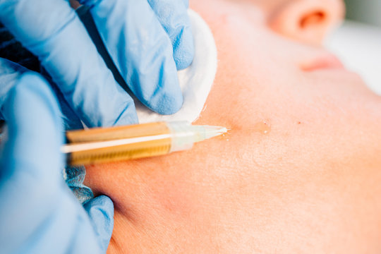 Plasma lifting - injections of blood plasma into the skin in the lower jaw area