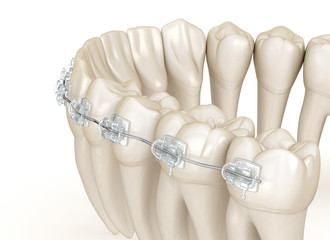 Teeth and Clear braces. 3D illustration concept