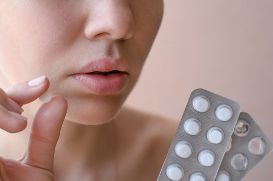 Part of a young woman's face with a virus herpes simplex on lips, treatment with pills