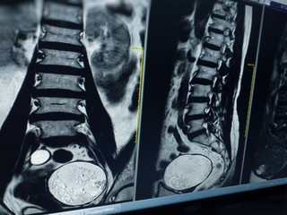 X-ray image Two views MRI lumbar spine showing Herniated nucleus pulposus of L4-L5 intervertebral disc,medical image concept.