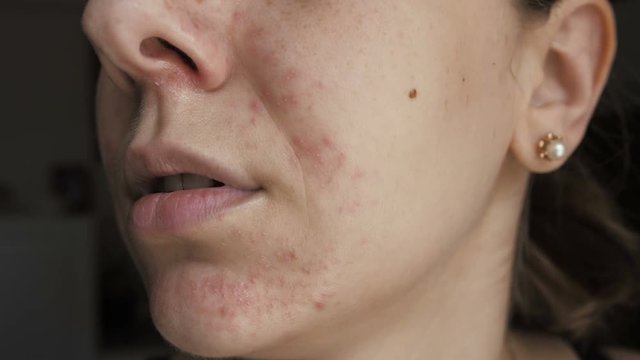 woman with a Allergy on the face, dermatitis