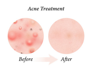 Skin acne treatment before and after. Vector skin acne pimples, facial cleanser and face cosmetic package design