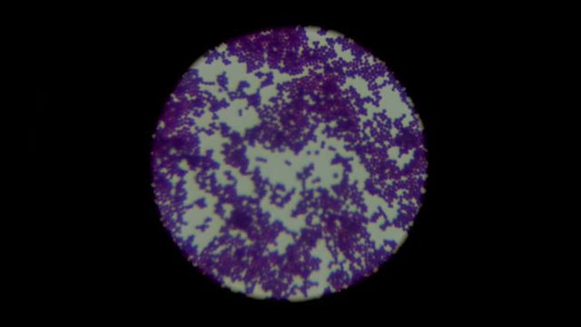 Smear of biological sample culture Gram's stained with gram positive staphylococcus under light microscope. Microbiology.