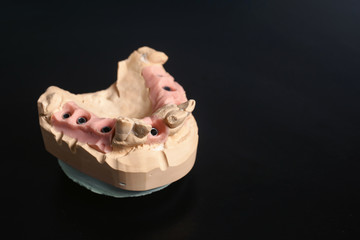 Obraz premium Dental jaw cast model and dental equipment on black background, concept medical image of dental healtcare, dental hygiene