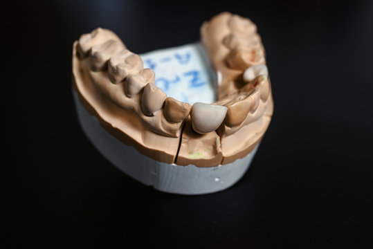 Dental jaw cast model and dental equipment on black background, concept medical image of dental healtcare, dental hygiene