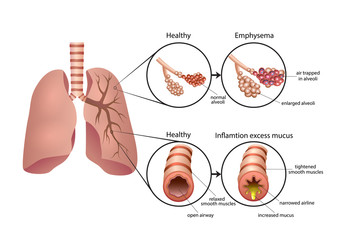 Chronic Obstructive Pulmonary Disease illustration