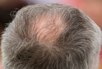 Bald head in the center of the man