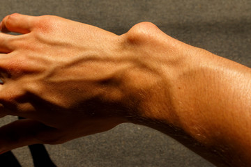 bulging bone on the wrist. damaged right hand caused by dyschondroplasia disease. broken right arm...