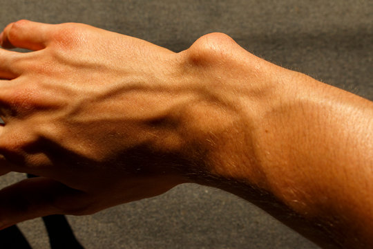 bulging bone on the wrist. damaged right hand caused by dyschondroplasia disease. broken right arm of Caucasian man. .