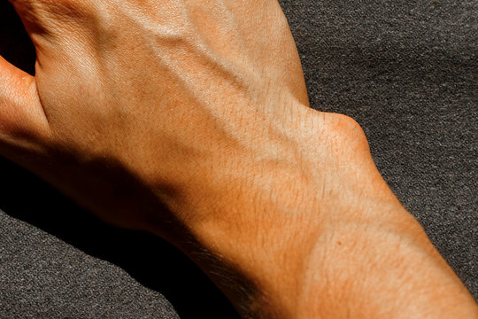 The bulging bone on the right hand that requires surgery. bulging bone on the wrist. damaged right hand. broken right arm of Caucasian man.