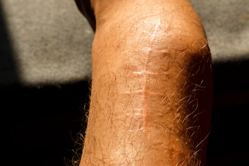scar on the leg. Human leg with old postoperative scar of Shin joint surgery. Detail of skin with...