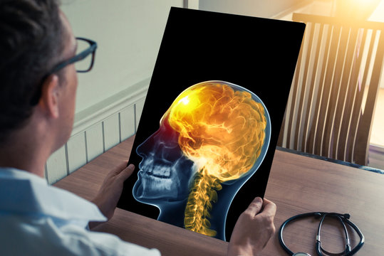 Doctor holding a x-ray of skull head with pain in the front of brain in medical office. Headache migraine or trauma concept