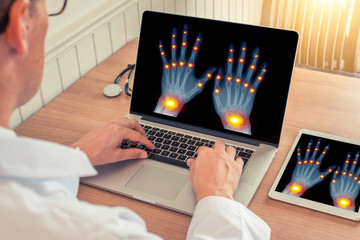 Doctor watching a laptop with x-ray of hands with osteoarthritis pain relief in the joints of the...