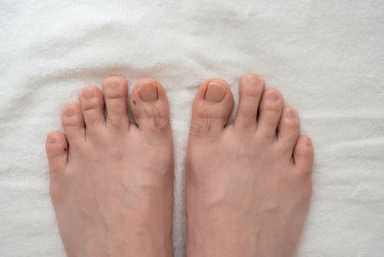 メンズ　足指脱毛　beforeイメージ