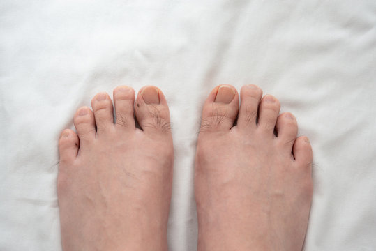 メンズ　足指脱毛　beforeイメージ