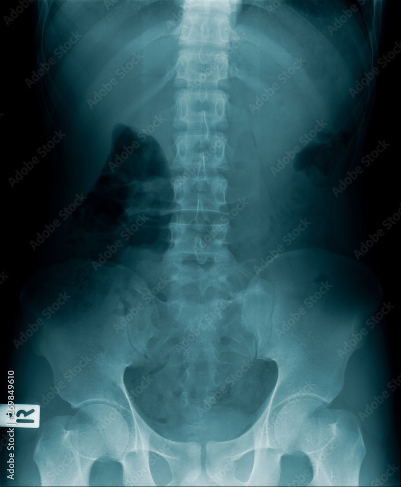 Sticker x-ray image of human spine