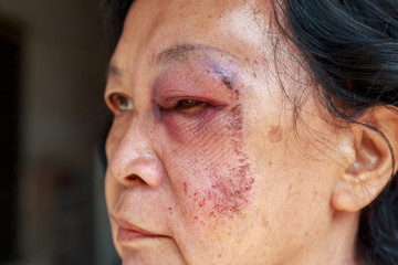 Elderly injury to the eyelid