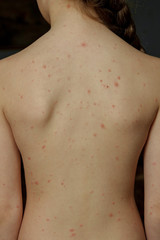 Chickenpox virus, chickenpox or measles. Close-up of a naked body of a child with chickenpox acne. Inflammation of the skin. Healthcare concept. Shingles