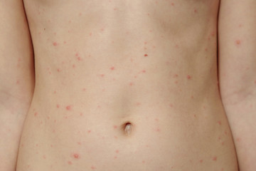Chickenpox virus, chickenpox or measles. Close-up of a naked body of a child with chickenpox acne....