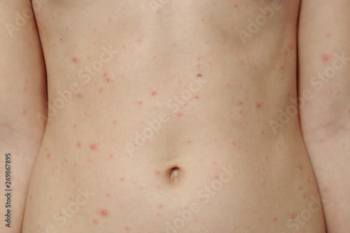 Chickenpox Virus Chickenpox Or Measles Close Up Of A Naked Body Of