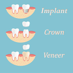 Teeth procedure of implant, crown, veneer restoration. Process stomatology prosthesis