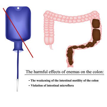 The harmful effects of enemas on the colon in constipation. Feces in the intestines. Infographics. Vector illustration on isolated background.