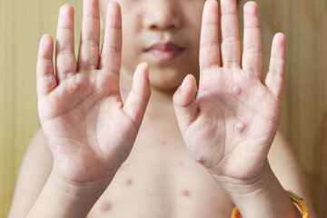 Chicken pox rash on young boy body.Chickenpox is an infection caused by the varicella zoster virus. It begins as a blister-like rash that originates on the face and trunk