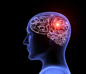 Obraz premium Human headache migraine