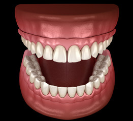 Maxillary and Mandibular prosthesis with gum All on 4 system supported by implants. Medically accurate 3D illustration of human teeth and dentures