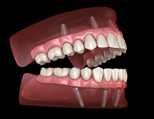 Maxillary and Mandibular prosthesis with gum All on 4 system supported by implants. Medically accurate 3D illustration of human teeth and dentures
